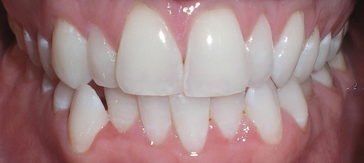Before treatment: crowding case published by ClearCorrect.